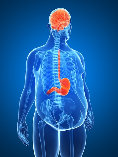 Diabetici obesi: il bypass gastrico riduce l’LDL-C come una statina