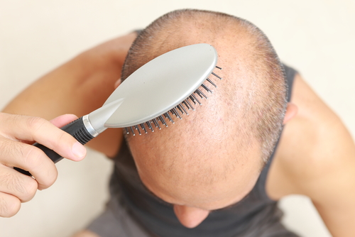 Alopecia androgenica: discutibile la sicurezza della finasteride