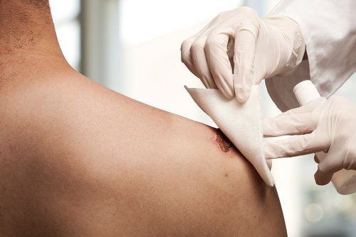 La ferita è infetta? lo sapremo in un minuto