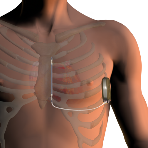 Cardiomiopatie non ischemiche: ICD migliorano sopravvivenza