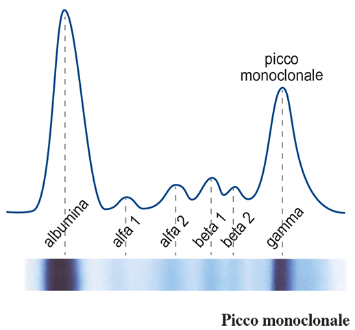 Mieloma multiplo, sopravvivenza migliore se consapevoli della propria gammopatia