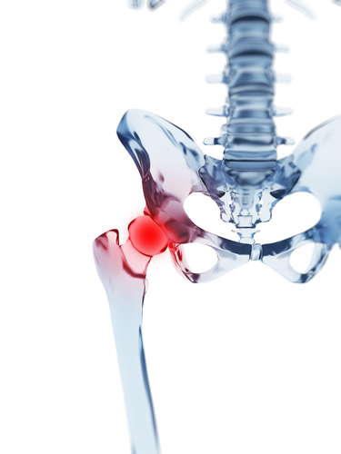 Osteoartrosi dell’anca connessa ad un aumento della mortalità