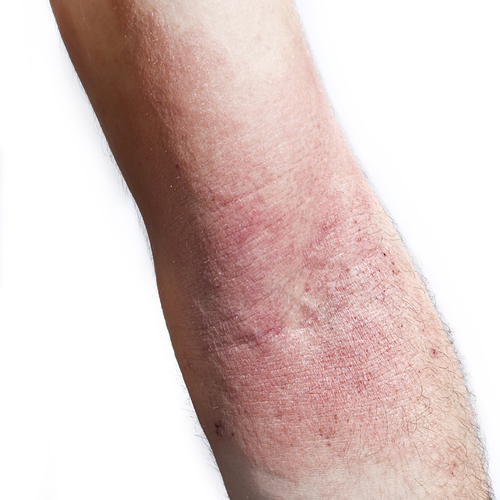 Infezioni cutanee: due popolari antibiotici parimenti efficaci