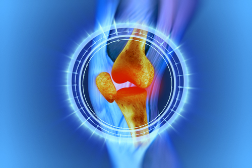 Osteoartrosi del ginocchio: efficace il plasma ricco di piastrine