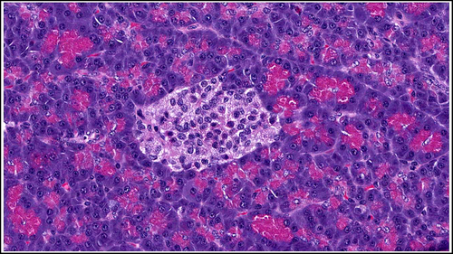 Trapianto insulare e marcatore di insufficienza beta-cellulare