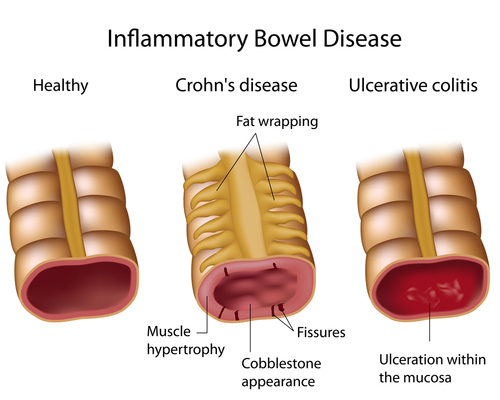 Malattie infiammatorie intestinali, infliximab e rischio chirurgia