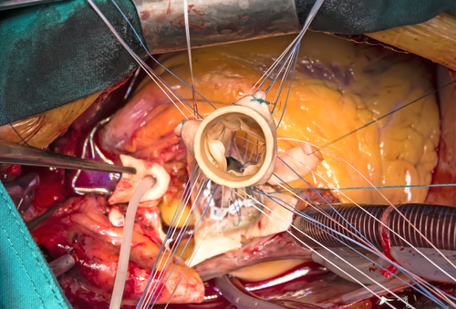 Protesi mitralica: biologica o meccanica?