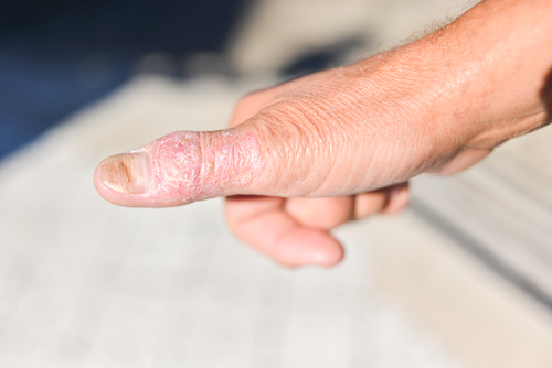 Psoriasi ungueale: efficacia dell’estratto di Indigo Naturalis