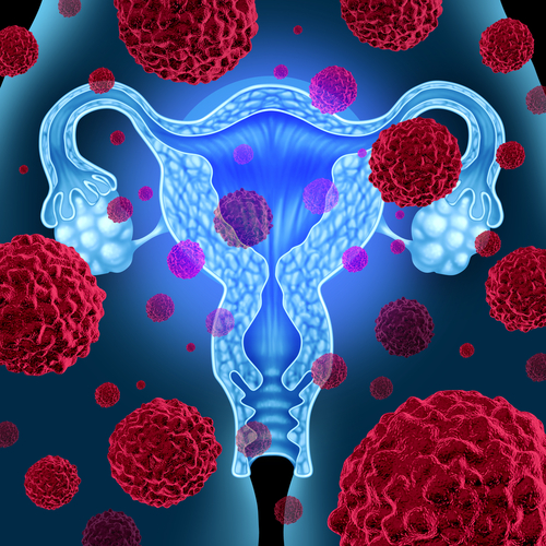 Legame tra leiomioma uterino, carcinoma ovarico e altre neoplasie