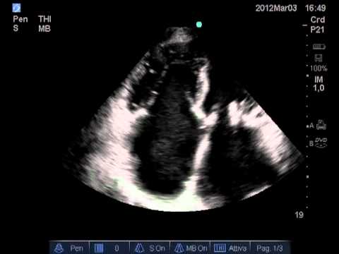 Insufficienza tricuspidale e ingrossamento del ventricolo destro associati a aumento della mortalità