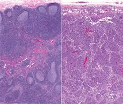 Linfoma di Hodgkin nei pazienti pediatrici, nuove linee guida