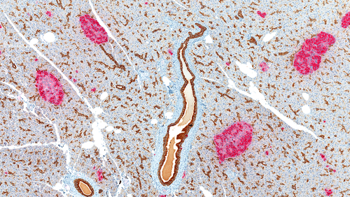 Diabete di tipo 1, è possibile recuperare la funzionalità beta-cellulare?