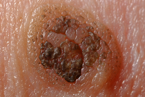 Toscana boom di tumori cutanei