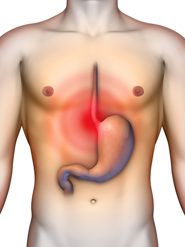 Fundoplicatio transorale non invasiva, migliora i sintomi e scongiura gli effetti collaterali