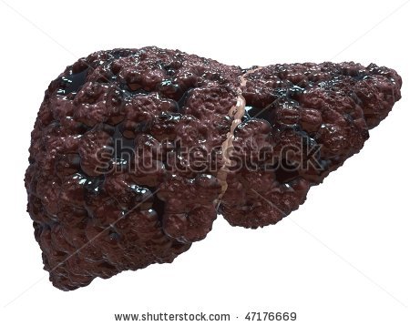 Epatite C, sviluppo rapido di fibrosi e successiva cirrosi