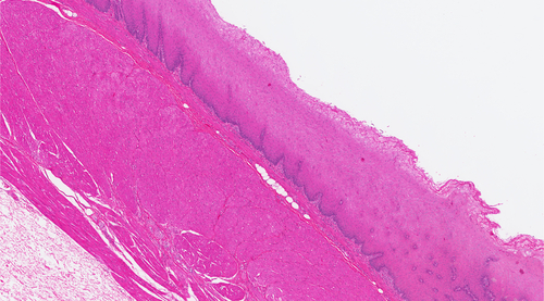 Esofago di Barrett: screening associato a diagnosi tumorali precoci