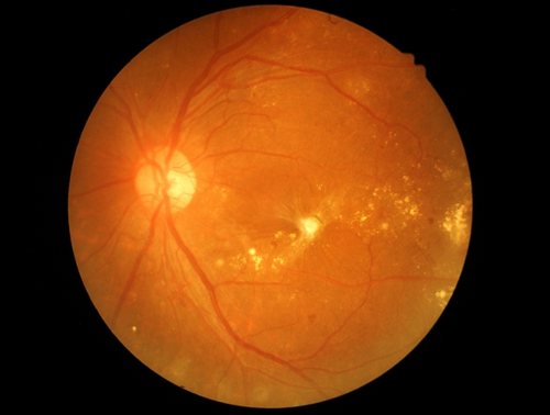 La stratificazione del rischio riduce gli esami oftalmici non necessari