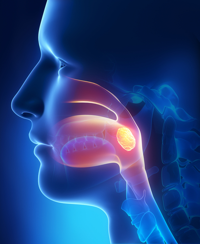 Tumori tonsillari: ruolo protettivo della tonsillectomia