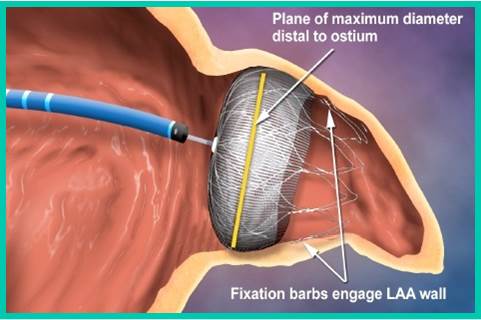 Fibrillazione atriale non valvolare: soluzione innovativa per ridurre il rischio di ictus