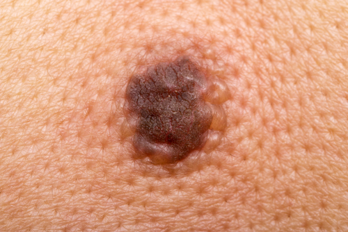 Melanoma: al via campagna di prevenzione