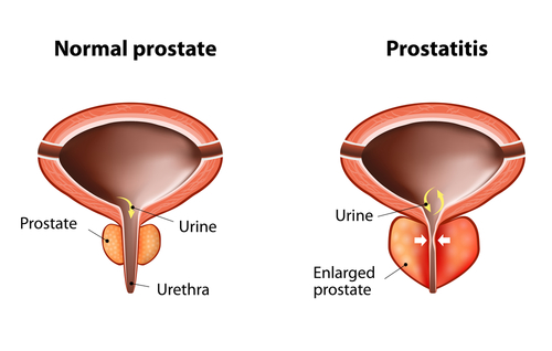 Prostatite cronica: meno dolore con l’agopuntura 