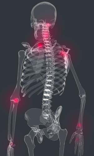 Fibromialgia giovanile: la terapia intensiva allevia il dolore