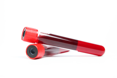 Tumori colon retto: un esame del sangue controlla l’effetto dei farmaci