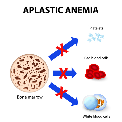 Anemia aplastica: mutazioni connesse ad esiti clinici