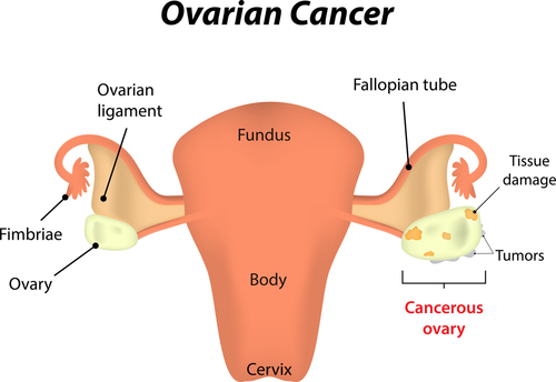 Tumori ovarici: ruolo delle sezioni congelate