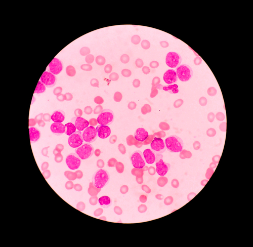 Leucemia mieloide: arriva il network per calcolare le alterazioni genetiche