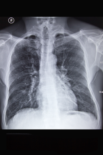Immunoterapia con PD-inibitori: frequenti le polmoniti