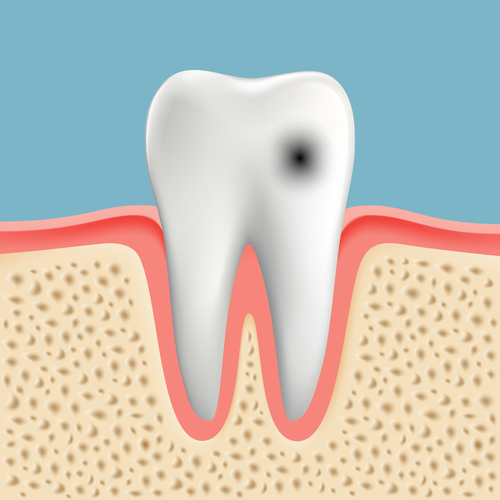 Prevenzione della carie dopo radioterapia contro i tumori della testa e del collo