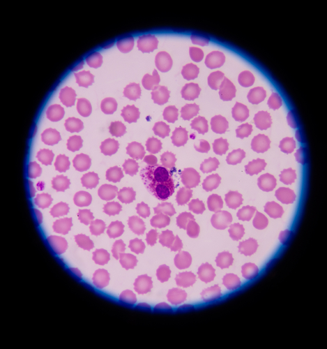 Malattie infiammatorie intestinali infantili: frequente l’eosinofilia periferica