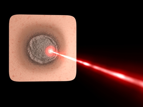 Dermatite da radiazioni: efficace laserterapia di basso livello