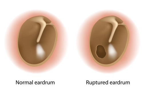 Perforazione del timpano: calcificazione importante nella rigenerazione