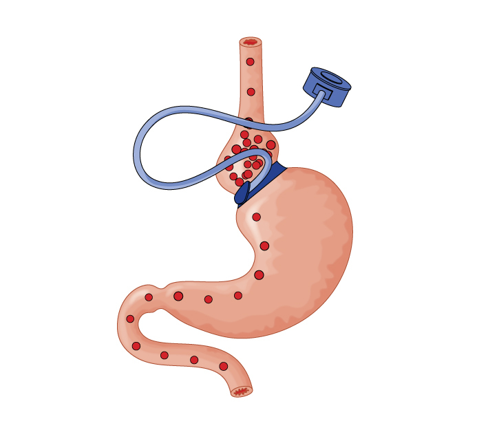 Chirurgia bariatrica: vitamina D, calcio ed esercizio rallentano perdita d’osso