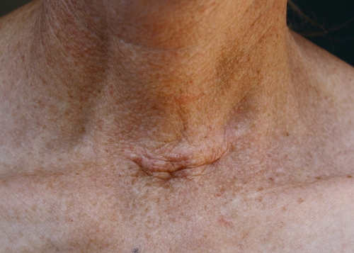 Tumore alla gola avanzato: chirurgia moltiplica possibilità di sopravvivenza