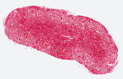 Emangiomi infantili: nuovo documento AAP