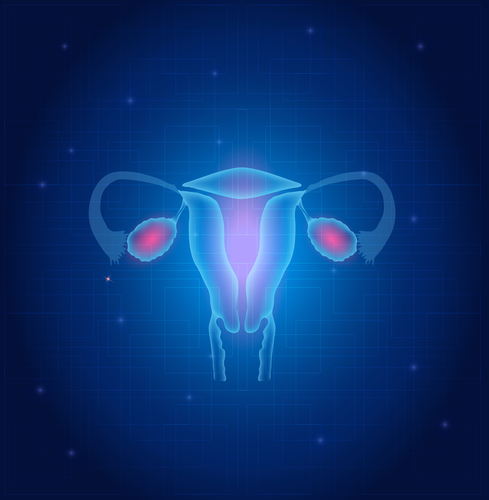 Ascite dopo intervento tumore ovaio: bene la gestione con terapia parenterale, somatostatina e paracentesi