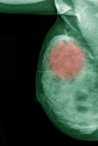 Irradiazione mammaria parziale efficace quanto quella totale