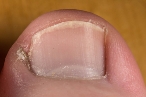 Lesioni ungueali nei pazienti con HIV co-infettati dal vaiolo delle scimmie