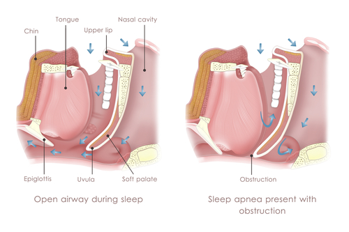Apnea ostruttiva nel sonno: neurostimolazione ancora efficace dopo tre anni