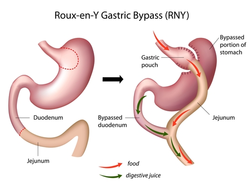 Bypass gastrico: comuni sintomi e ricoveri