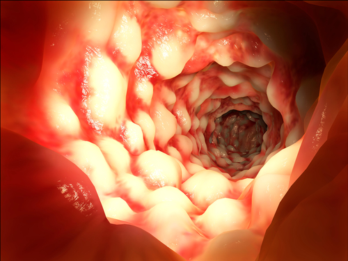 Malattia di Crohn: messo a punto sensore impiantabile che rileva riacutizzazioni
