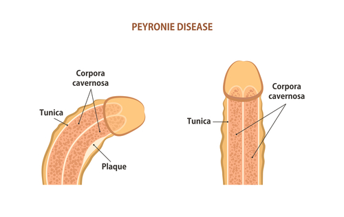 Malattia di Peyronie: promettente trattamento topico