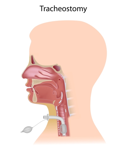 Conveniente tracheostomia senza broncoscopia