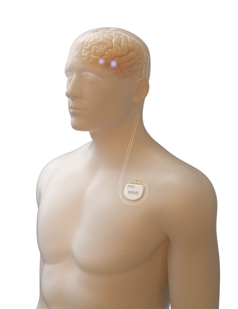 Parkinson: l’efficacia del Sistema di Stimolazione Cerebrale Profonda  (DBS) Vercise™