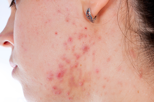 Acne: telemedicina per gestione terapia bene accetta dal paziente