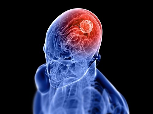 Terapia con cellule CAR-T contro il glioblastoma