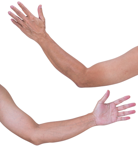 Insufficienza cardiaca: circonferenza braccio e BMI affinano la previsione del rischio